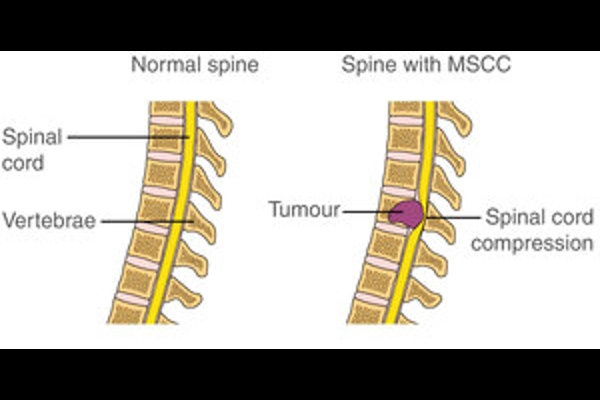 MACD242 Malignant+Spinal+Cord_600x400